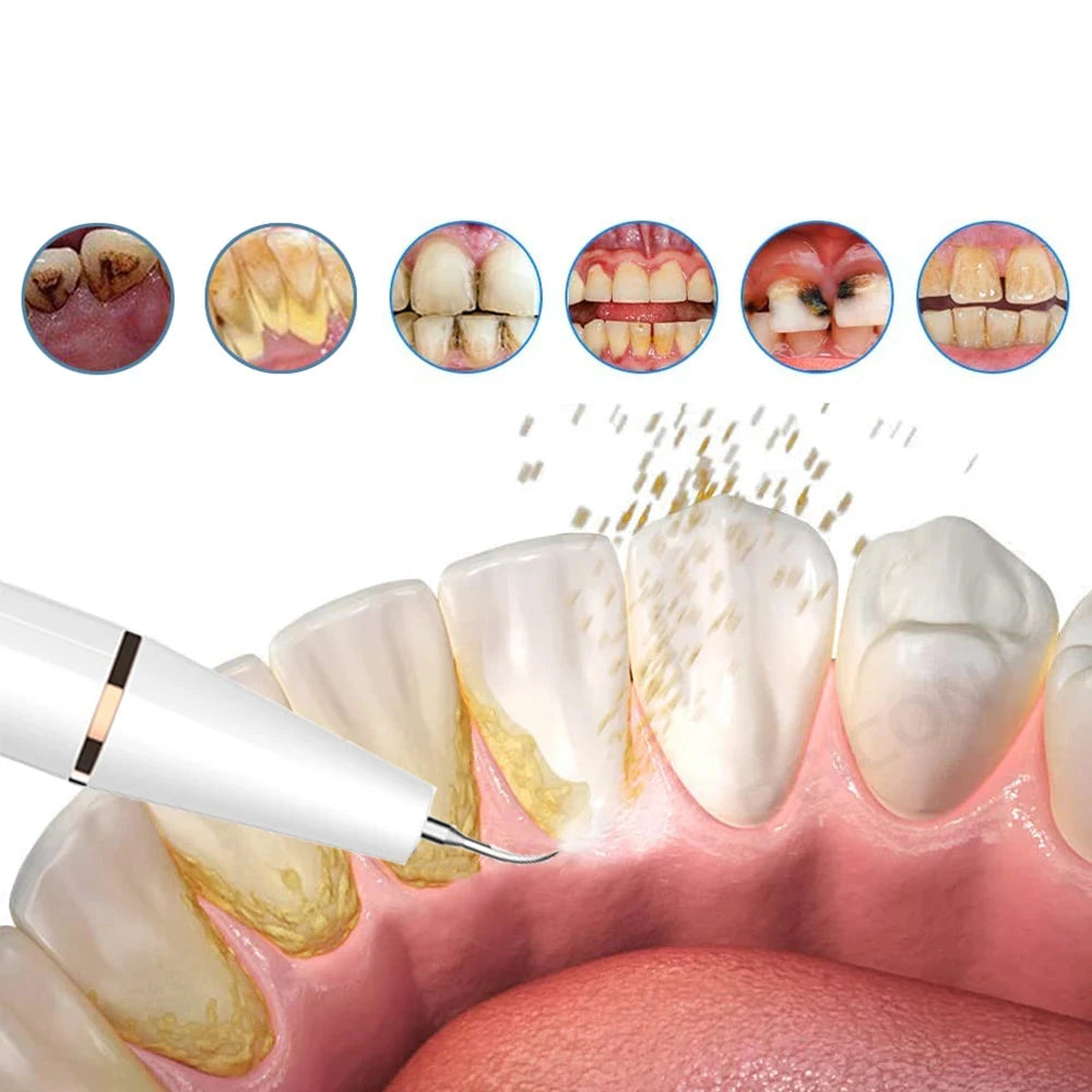 Dentara | Ultraschall-Zahnhygiene – Effektive Plaque- und Tartarentfernung für Zuhause 1