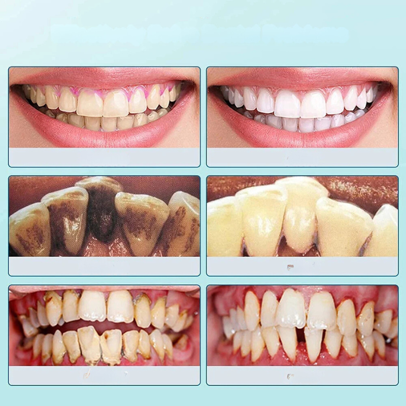 Dentara | Ultraschall-Zahnhygiene – Effektive Plaque- und Tartarentfernung für Zuhause 2